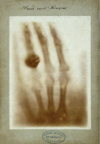 Anna Bertha Ludwig&#39;s hand pictured in an X-ray.